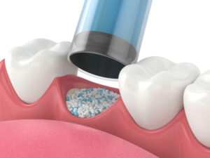 encinitas jawbone grafting