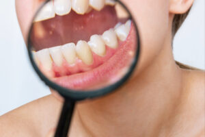 encinitas gum grafts