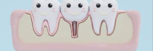 encinitas jawbone grafting